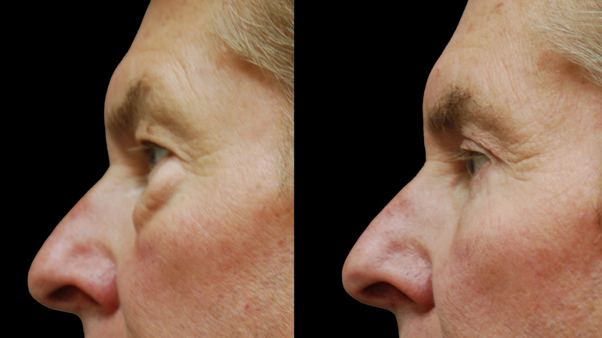 Upper & Lower Eyelid Surgery Before & After Gallery - Patient 181231 - Image 9