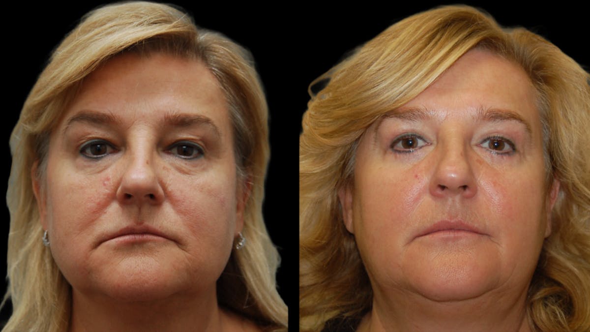 Upper & Lower Eyelid Surgery Before & After Gallery - Patient 759582 - Image 1