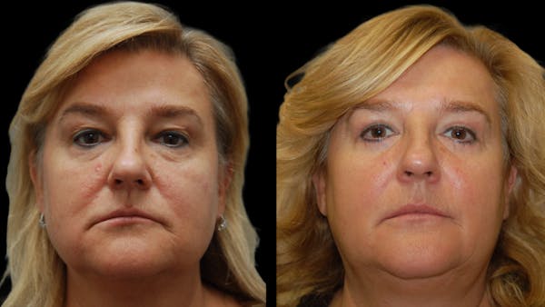 Upper & Lower Eyelid Surgery Before & After Gallery - Patient 759582 - Image 1