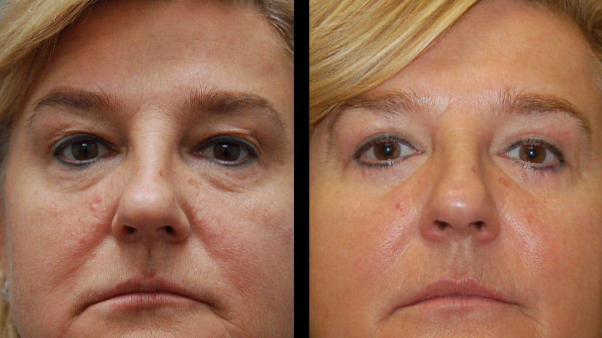 Upper & Lower Eyelid Surgery Before & After Gallery - Patient 759582 - Image 2