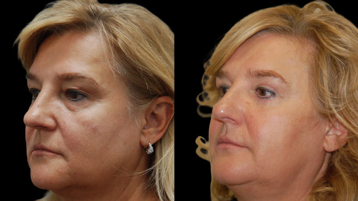 Upper & Lower Eyelid Surgery Before & After Gallery - Patient 759582 - Image 3