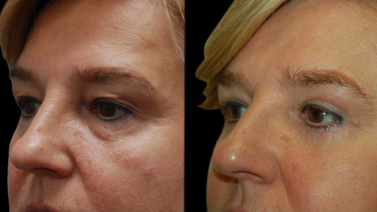 Upper & Lower Eyelid Surgery Before & After Gallery - Patient 759582 - Image 4