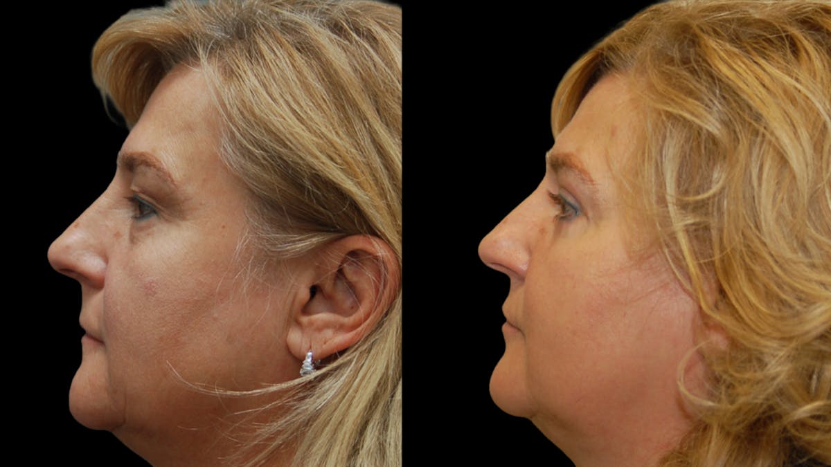 Upper & Lower Eyelid Surgery Before & After Gallery - Patient 759582 - Image 5