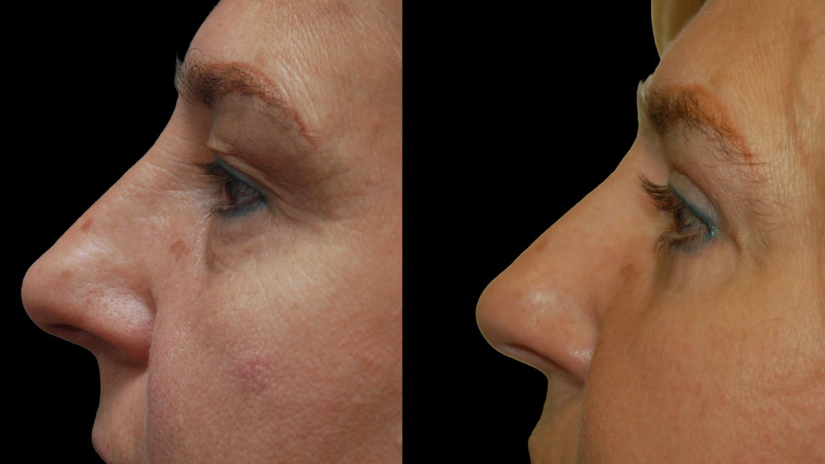 Upper & Lower Eyelid Surgery Before & After Gallery - Patient 759582 - Image 6