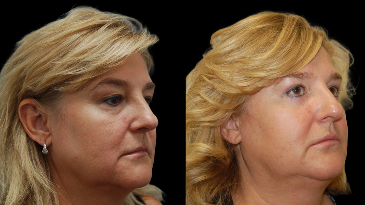 Upper & Lower Eyelid Surgery Before & After Gallery - Patient 759582 - Image 7