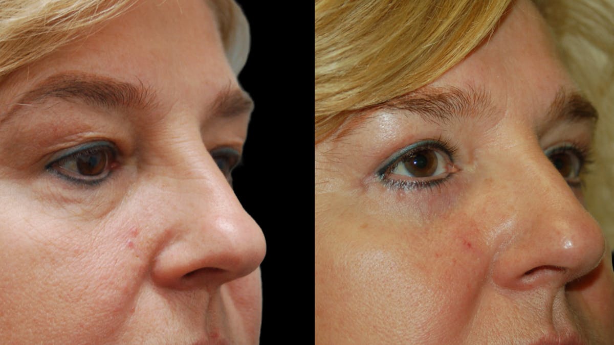 Upper & Lower Eyelid Surgery Before & After Gallery - Patient 759582 - Image 8