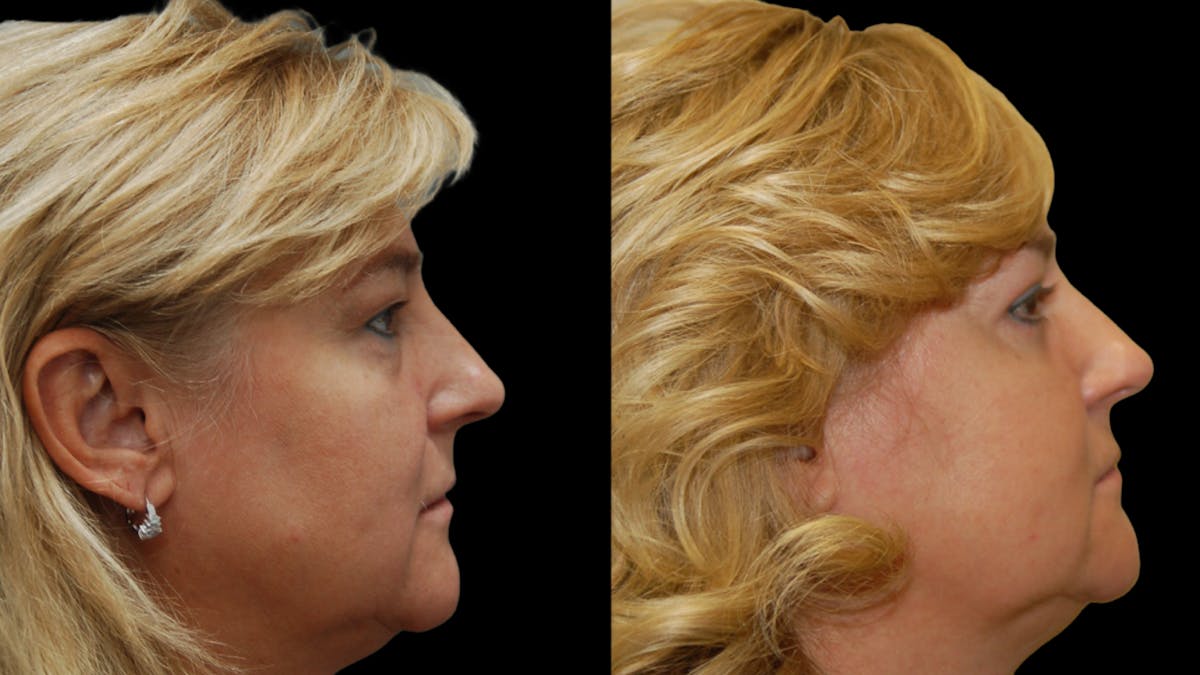 Upper & Lower Eyelid Surgery Before & After Gallery - Patient 759582 - Image 9