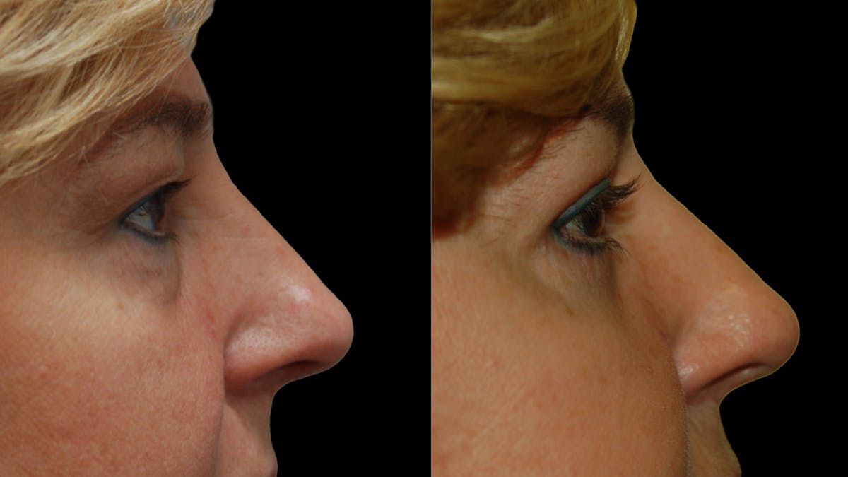 Upper & Lower Eyelid Surgery Before & After Gallery - Patient 759582 - Image 10