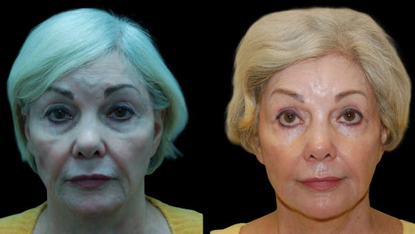 Upper & Lower Eyelid Surgery Before & After Gallery - Patient 224433 - Image 1