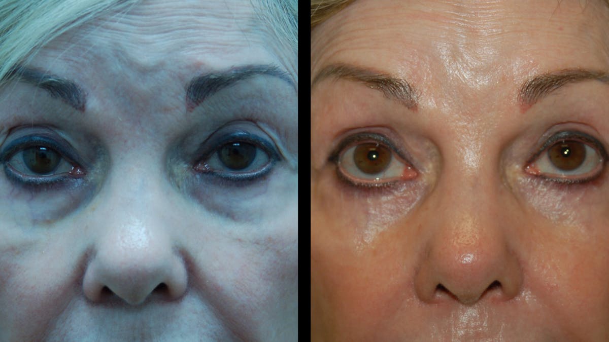 Upper & Lower Eyelid Surgery Before & After Gallery - Patient 224433 - Image 2
