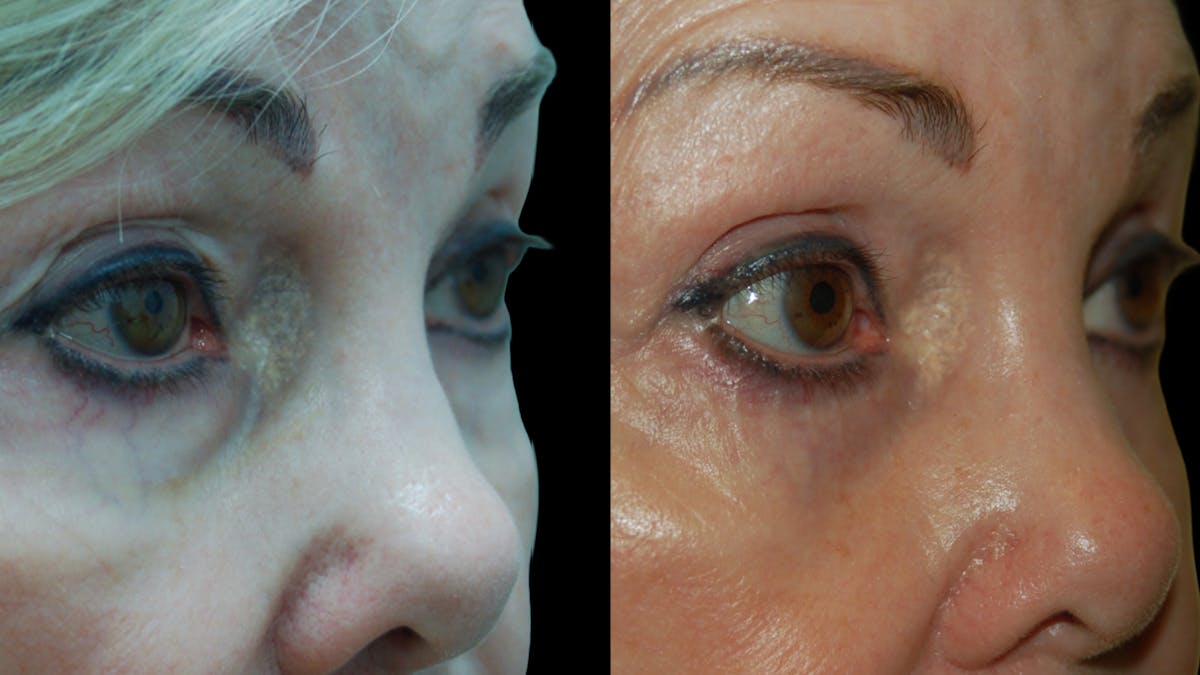 Upper & Lower Eyelid Surgery Before & After Gallery - Patient 224433 - Image 4