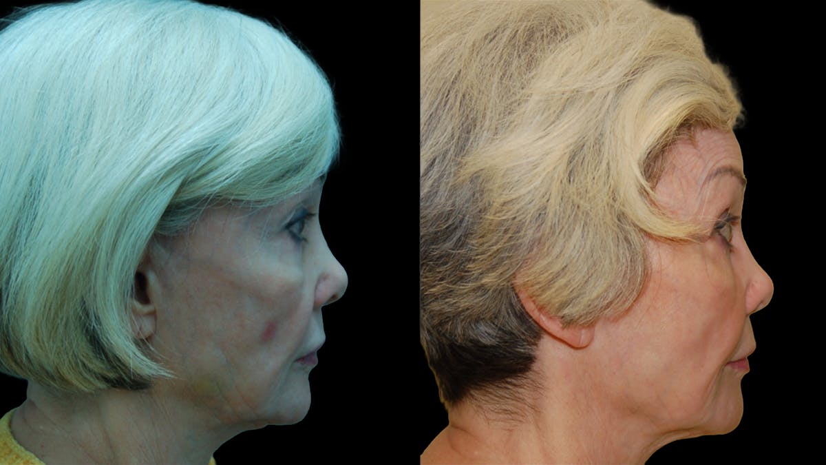 Upper & Lower Eyelid Surgery Before & After Gallery - Patient 224433 - Image 5