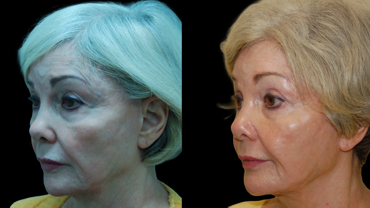 Upper & Lower Eyelid Surgery Before & After Gallery - Patient 224433 - Image 6