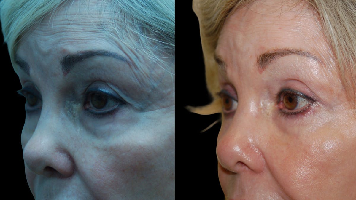 Upper & Lower Eyelid Surgery Before & After Gallery - Patient 224433 - Image 7