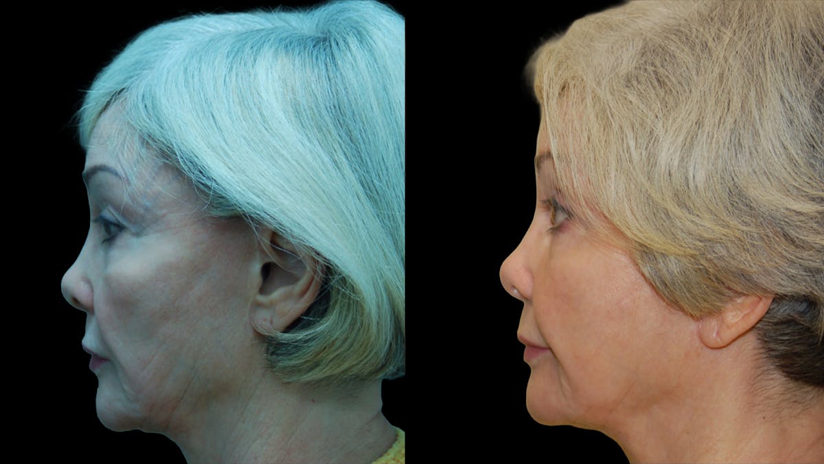 Upper & Lower Eyelid Surgery Before & After Gallery - Patient 224433 - Image 8