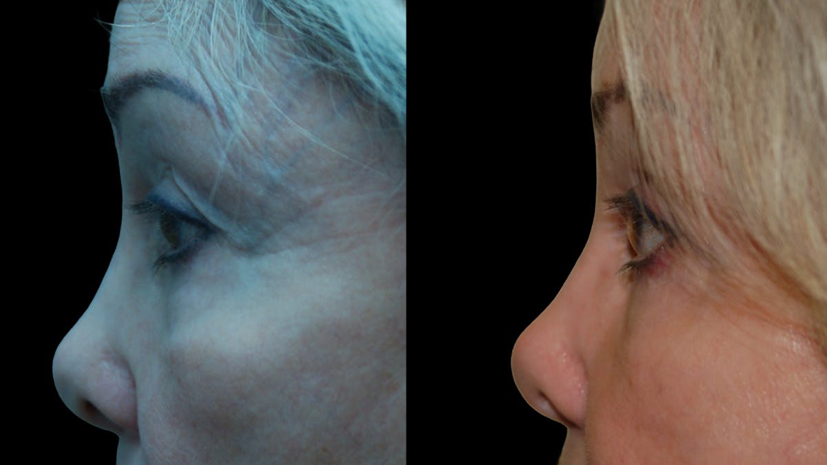 Upper & Lower Eyelid Surgery Before & After Gallery - Patient 224433 - Image 9