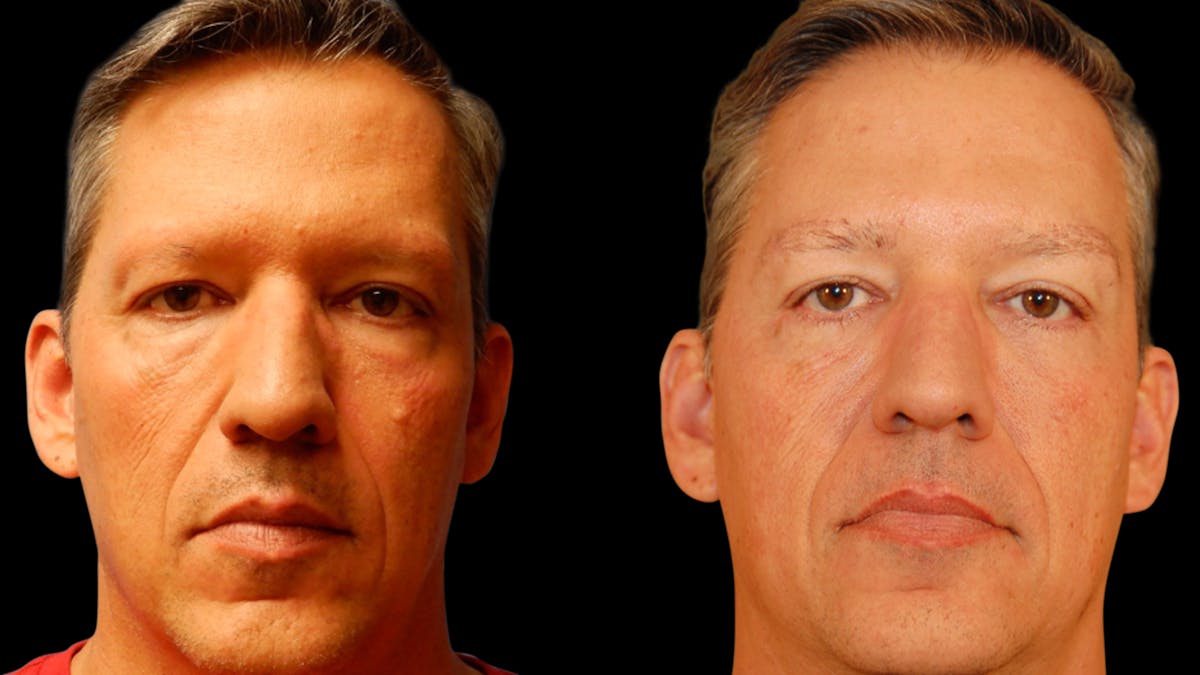 Upper & Lower Eyelid Surgery Before & After Gallery - Patient 199735 - Image 1