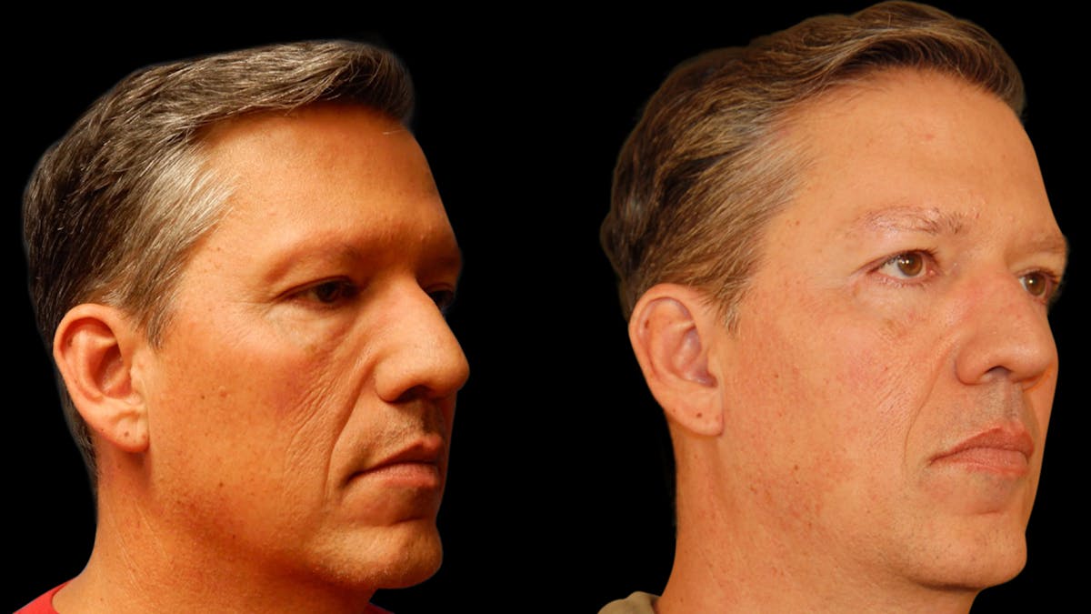 Upper & Lower Eyelid Surgery Before & After Gallery - Patient 199735 - Image 2