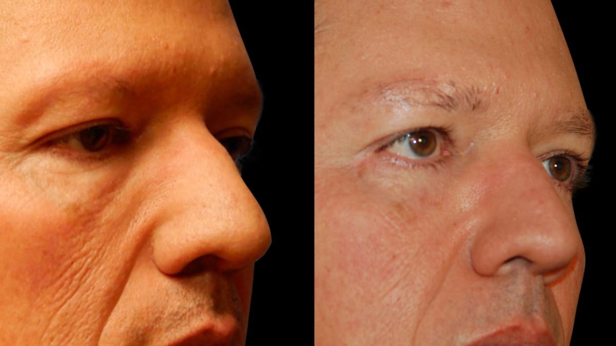 Upper & Lower Eyelid Surgery Before & After Gallery - Patient 199735 - Image 3