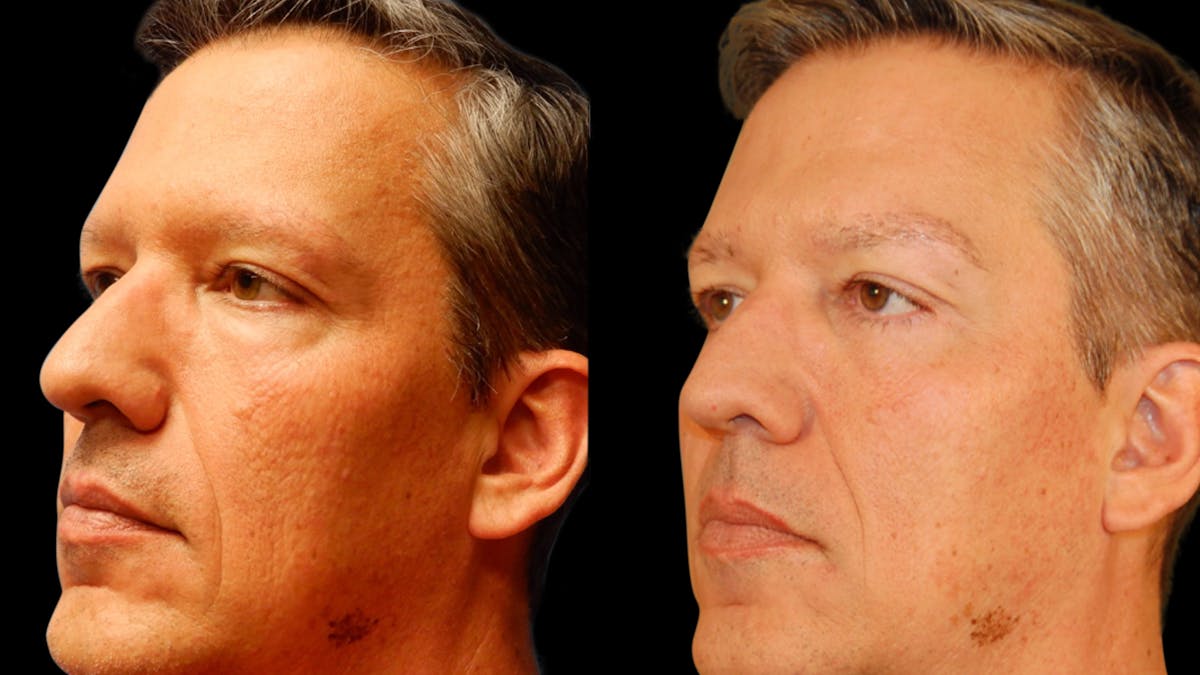 Upper & Lower Eyelid Surgery Before & After Gallery - Patient 199735 - Image 4