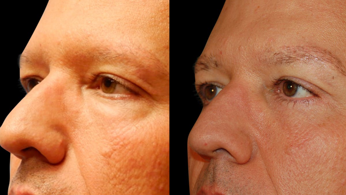 Upper & Lower Eyelid Surgery Before & After Gallery - Patient 199735 - Image 5
