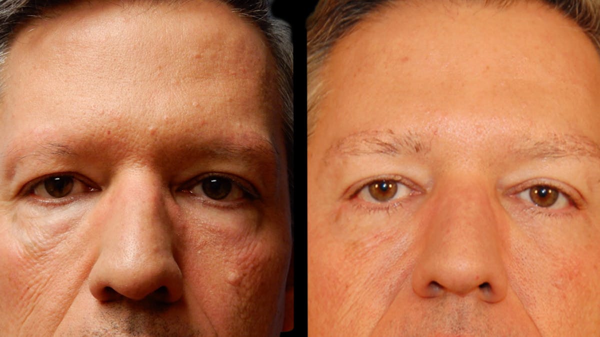 Upper & Lower Eyelid Surgery Before & After Gallery - Patient 199735 - Image 6