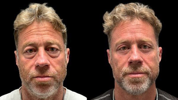 Upper & Lower Eyelid Surgery Before & After Gallery - Patient 423560 - Image 1