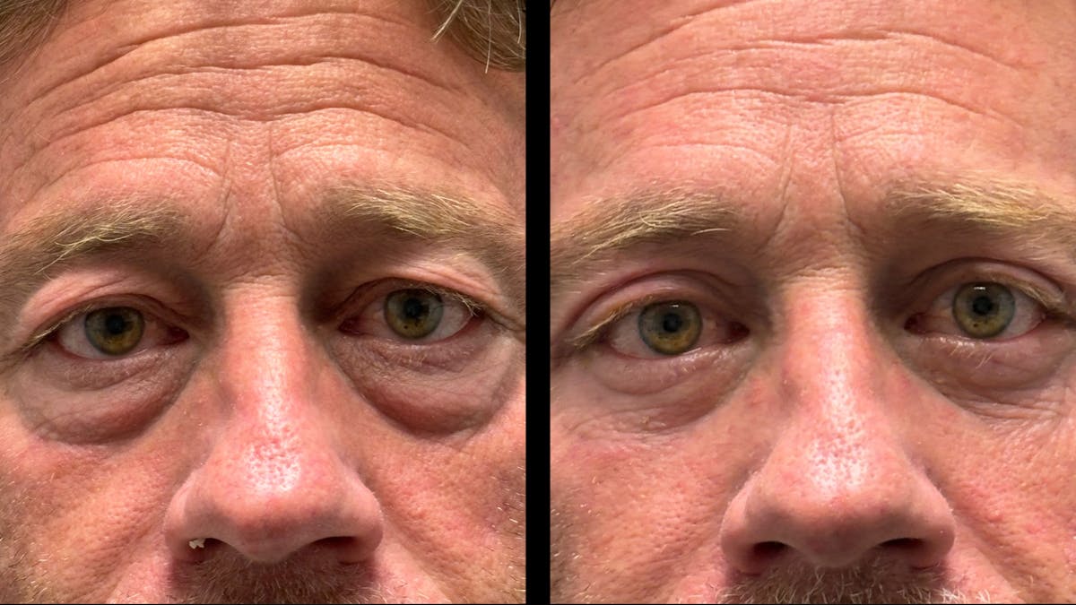 Upper & Lower Eyelid Surgery Before & After Gallery - Patient 423560 - Image 2