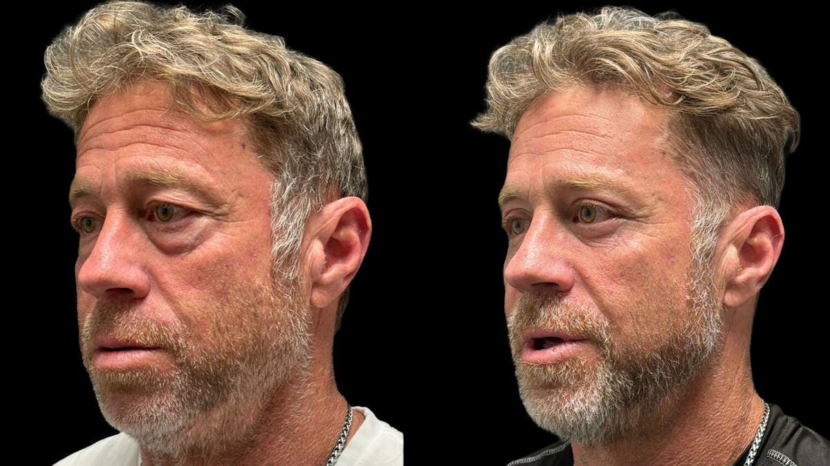 Upper & Lower Eyelid Surgery Before & After Gallery - Patient 423560 - Image 3