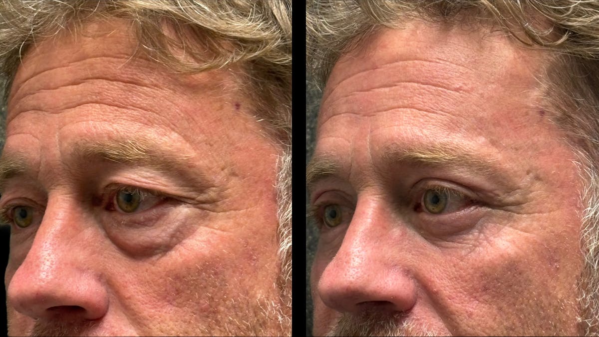 Upper & Lower Eyelid Surgery Before & After Gallery - Patient 423560 - Image 4