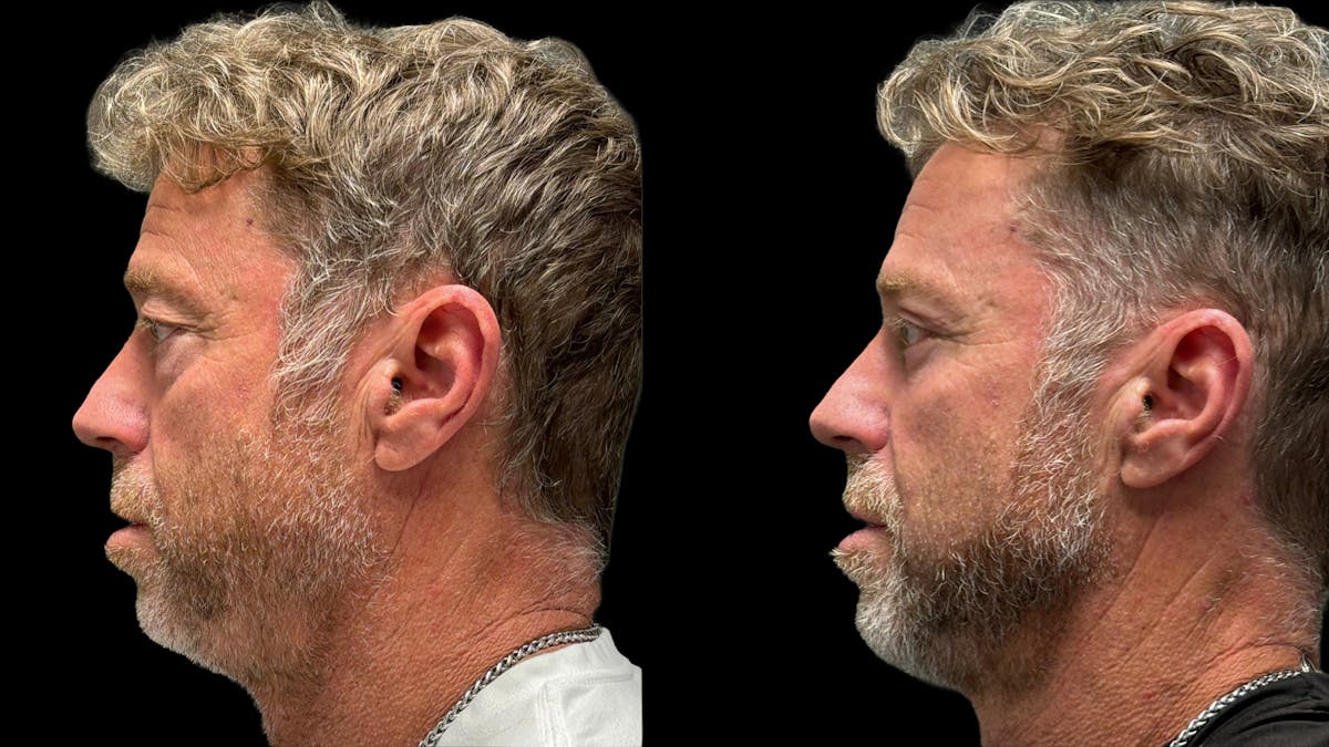 Upper & Lower Eyelid Surgery Before & After Gallery - Patient 423560 - Image 5