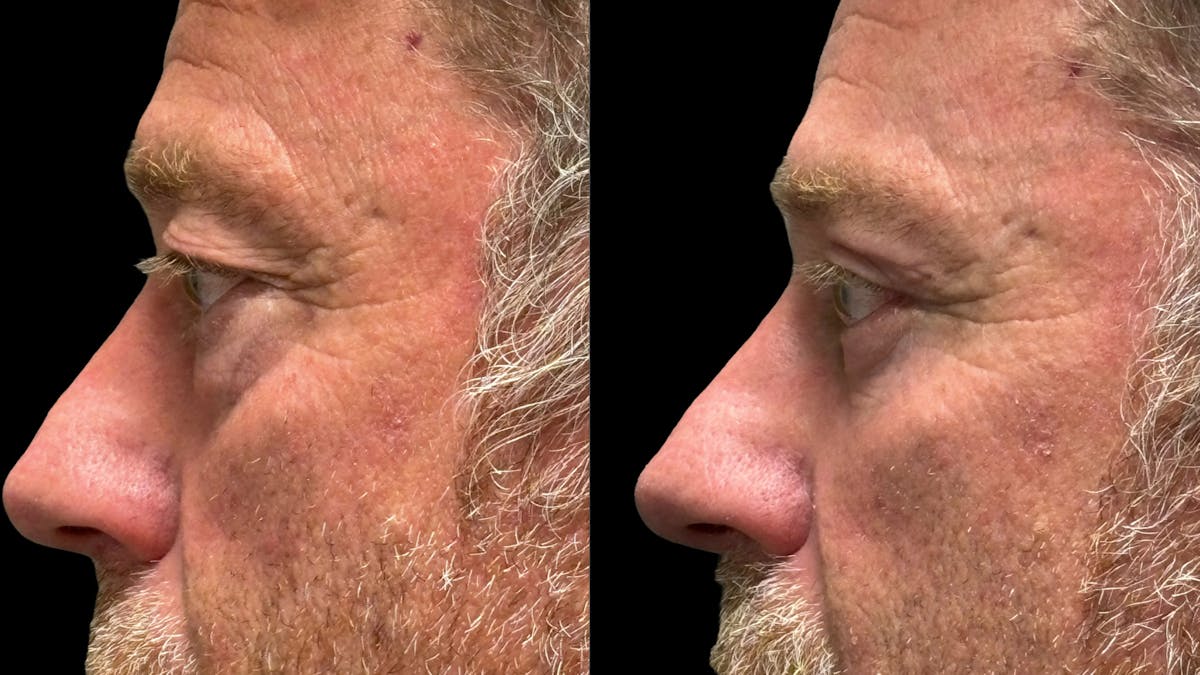 Upper & Lower Eyelid Surgery Before & After Gallery - Patient 423560 - Image 6