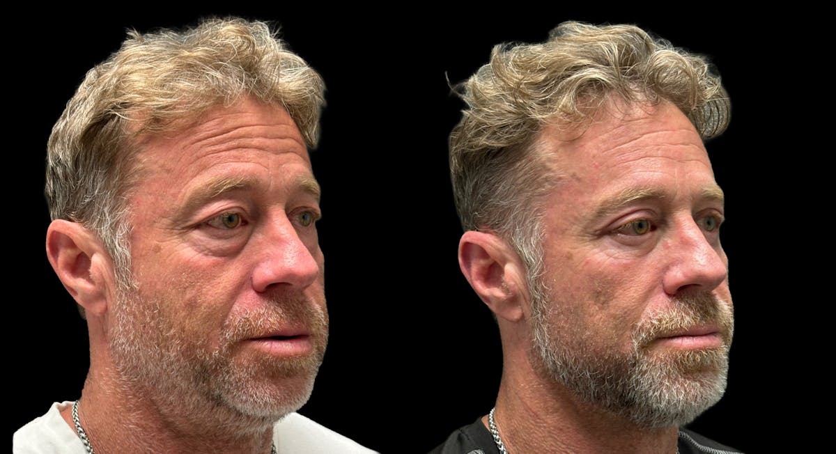 Upper & Lower Eyelid Surgery Before & After Gallery - Patient 423560 - Image 7