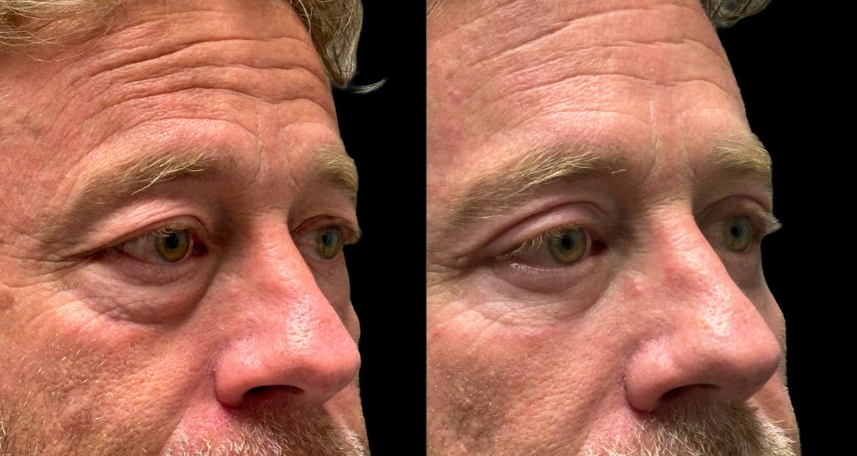 Upper & Lower Eyelid Surgery Before & After Gallery - Patient 423560 - Image 8