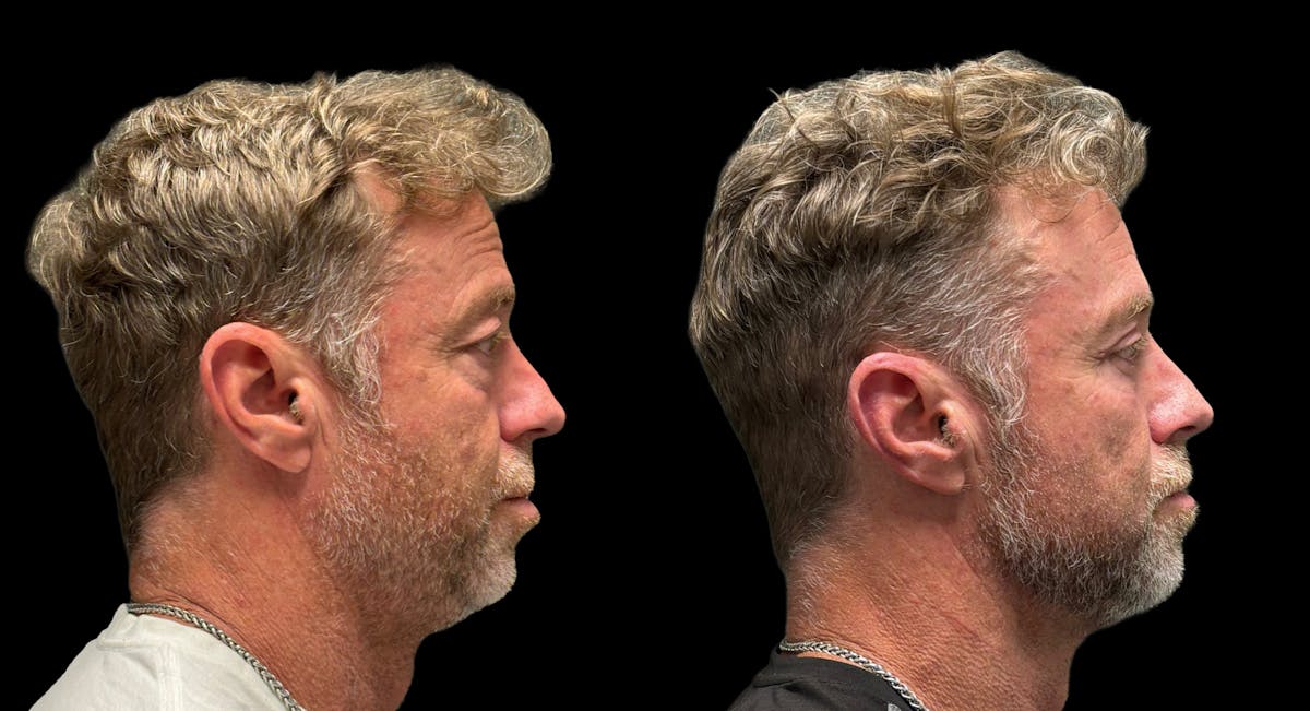 Upper & Lower Eyelid Surgery Before & After Gallery - Patient 423560 - Image 9