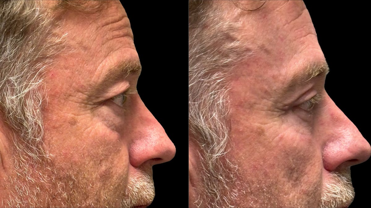 Upper & Lower Eyelid Surgery Before & After Gallery - Patient 423560 - Image 10