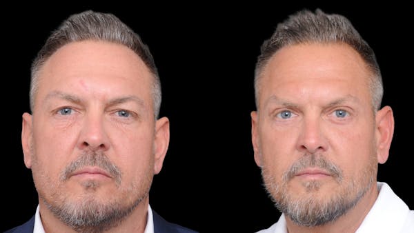 Upper & Lower Eyelid Surgery Before & After Gallery - Patient 312797 - Image 1