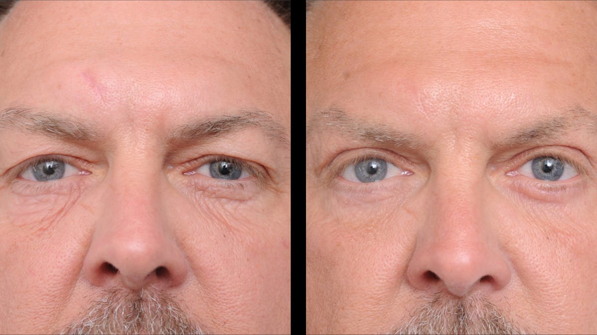 Upper & Lower Eyelid Surgery Before & After Gallery - Patient 312797 - Image 2