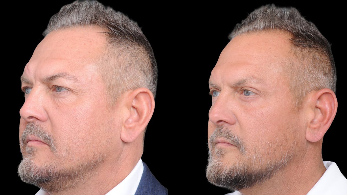 Upper & Lower Eyelid Surgery Before & After Gallery - Patient 312797 - Image 3