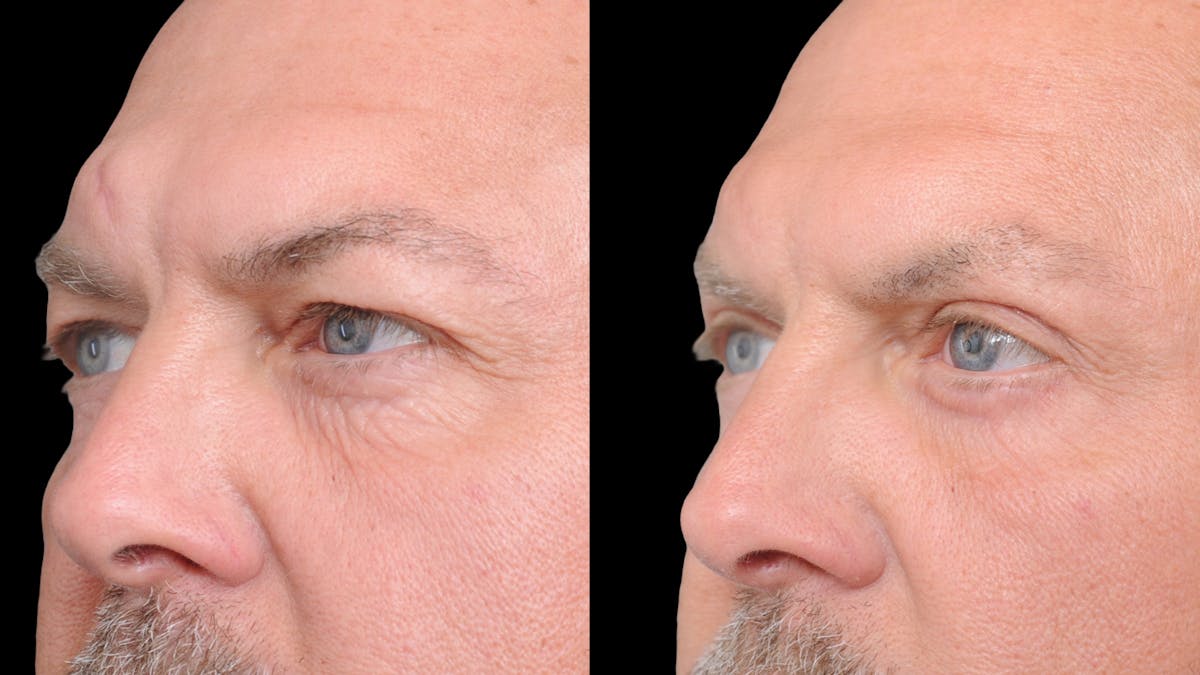 Upper & Lower Eyelid Surgery Before & After Gallery - Patient 312797 - Image 4