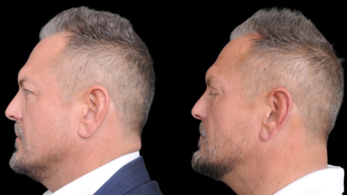 Upper & Lower Eyelid Surgery Before & After Gallery - Patient 312797 - Image 5