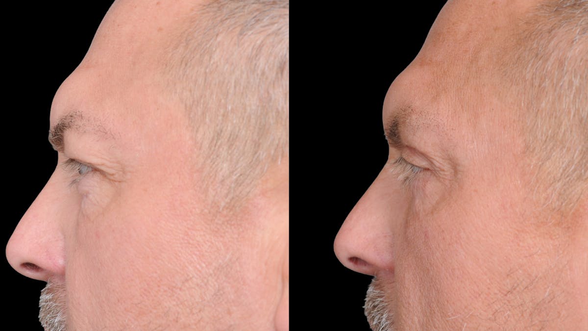 Upper & Lower Eyelid Surgery Before & After Gallery - Patient 312797 - Image 6