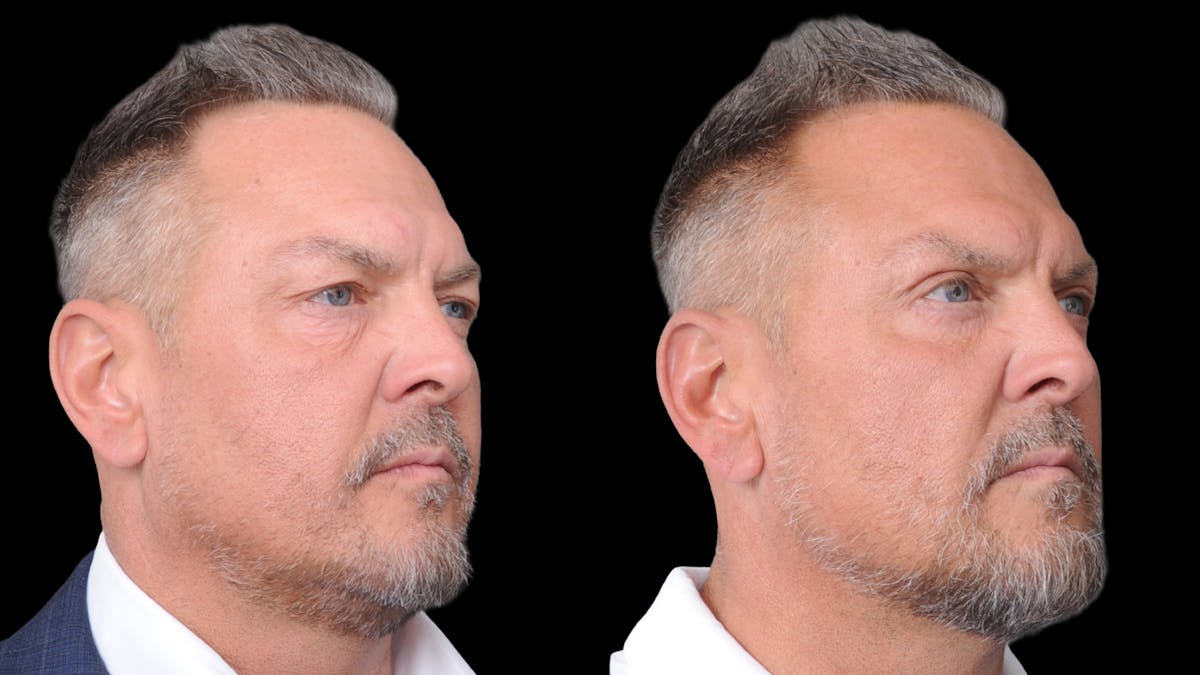 Upper & Lower Eyelid Surgery Before & After Gallery - Patient 312797 - Image 7
