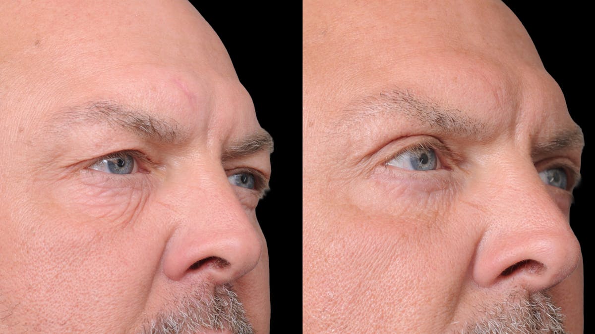 Upper & Lower Eyelid Surgery Before & After Gallery - Patient 312797 - Image 8