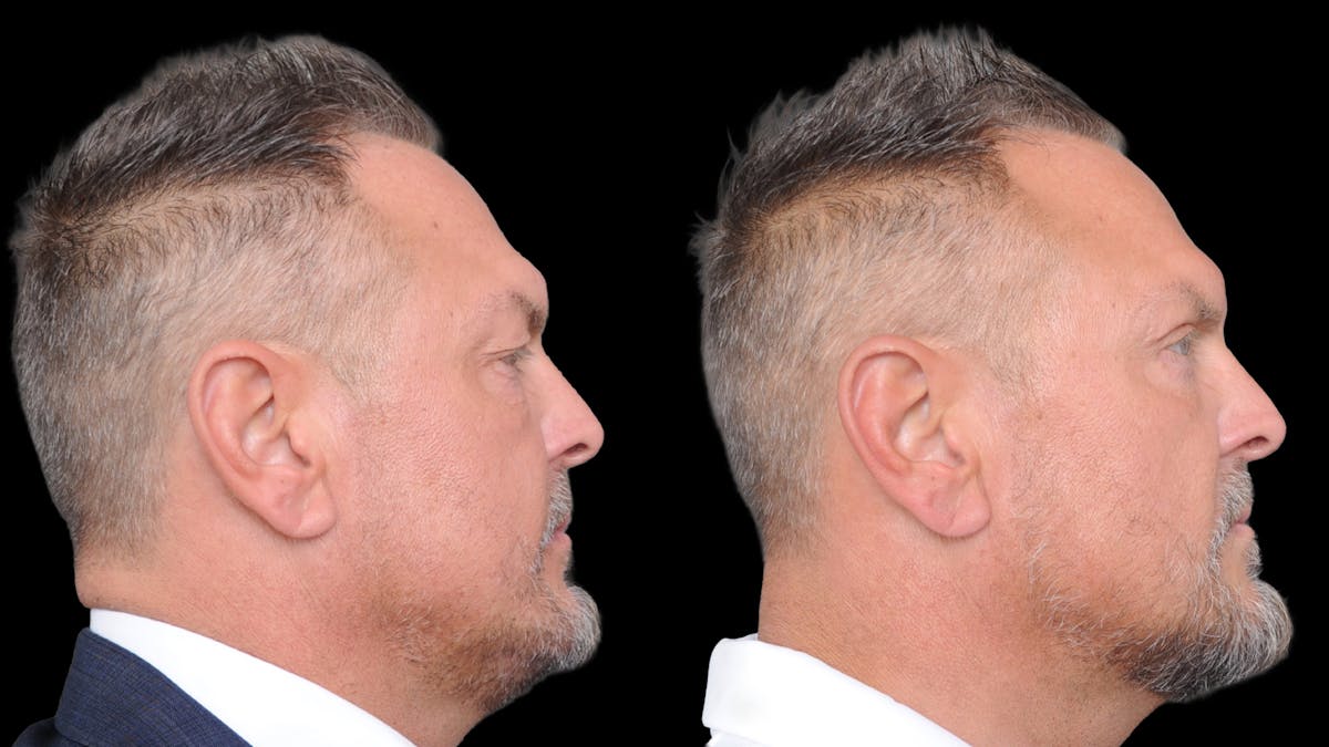 Upper & Lower Eyelid Surgery Before & After Gallery - Patient 312797 - Image 9