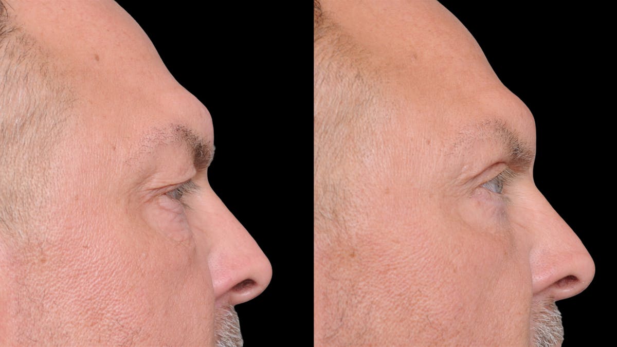 Upper & Lower Eyelid Surgery Before & After Gallery - Patient 312797 - Image 10