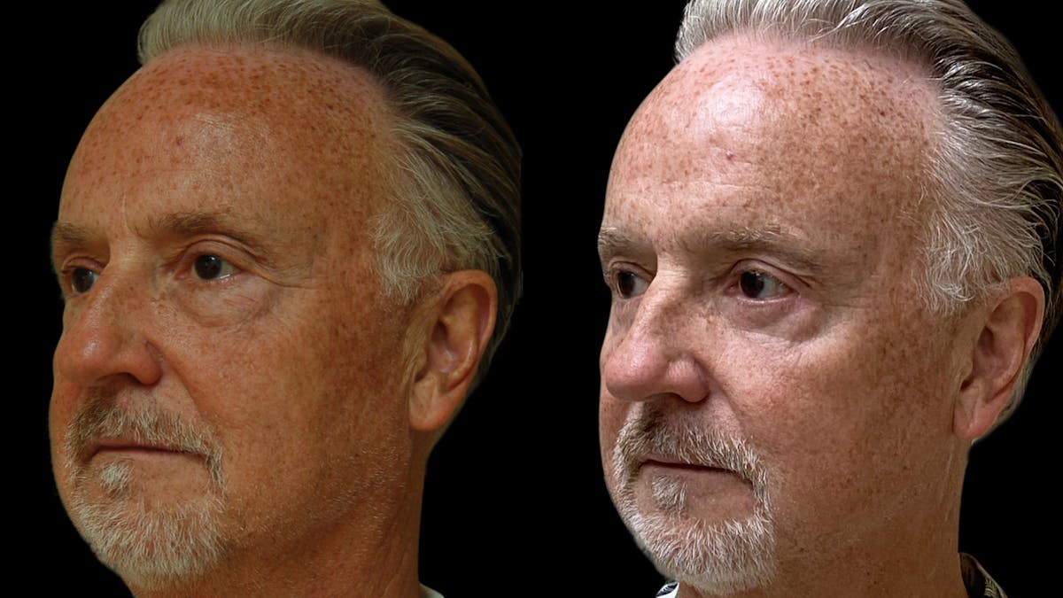 Upper & Lower Eyelid Surgery Before & After Gallery - Patient 330420 - Image 1