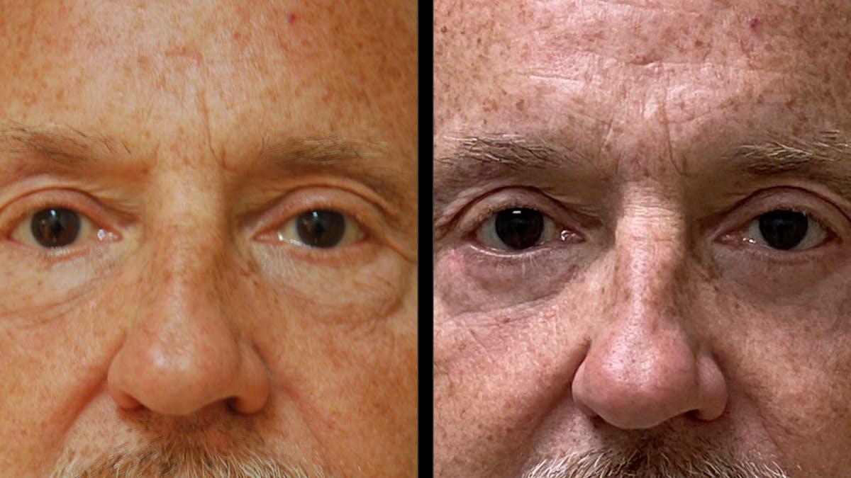 Upper & Lower Eyelid Surgery Before & After Gallery - Patient 330420 - Image 2