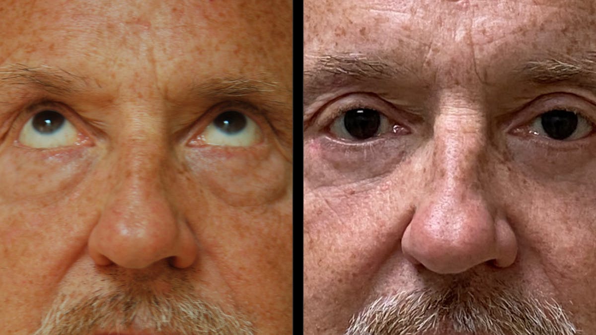 Upper & Lower Eyelid Surgery Before & After Gallery - Patient 330420 - Image 3