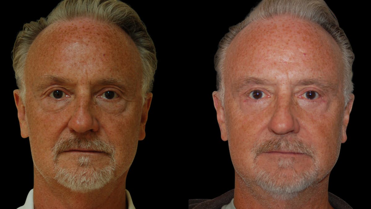 Upper & Lower Eyelid Surgery Before & After Gallery - Patient 330420 - Image 4